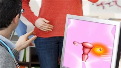 مرض ياسمين عبد العزيز.. 10 معلومات عن أكياس الشوكولاتة على المبيض وتأثيره على الحمل 