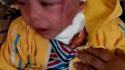 الفاعل كلب.. الداخلية تكشف تفاصيل إصابة طفل بكسر بالجمجمة بقرية كفر داود بالمنوفية