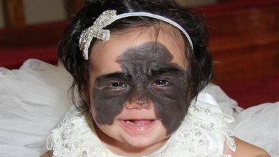 بعد عامين من العمليات الجراحية فقدت الصغيرة وحمة باتمان