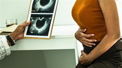 كيفية التعامل مع كيس شيكولاتة على المبيض الأيسر 4 سم