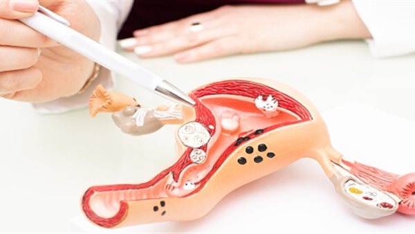  مرض بطانة الرحم