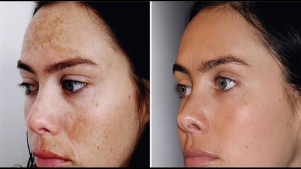 مصابي الكلف