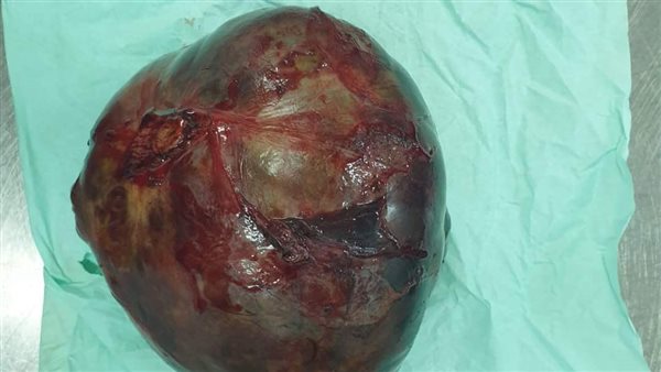 استئصال ورم يزن 200