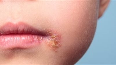 طبيبة أطفال عن فيروس هربس الفموي: يؤثر على المخ ويسبب التهابات عنيفة