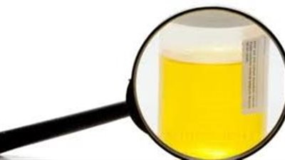 10 عوامل مرضية ضمن أسباب صديد البول عند النساء.. تعرفي عليها