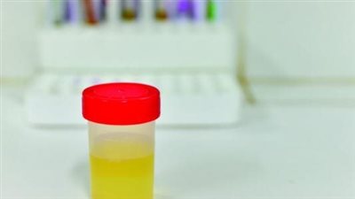 مدة علاج صديد البول بأعراضه البسيطة والشديدة بعد إجراء المزرعة