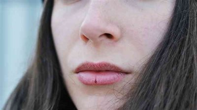 بخلاف الشتاء.. أمراض تسبب تشقق الشفاه أهمها اضطراب الغدة الدرقية