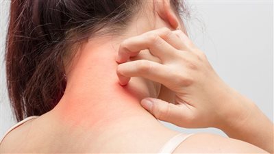 التهابات الجلد تسبب الحمى الروماتيزمية| دراسة 