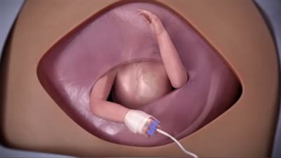 جراحة جنينية.. فريق طبي ينجح في إزالة ورم من قلب جنين داخل الرحم 