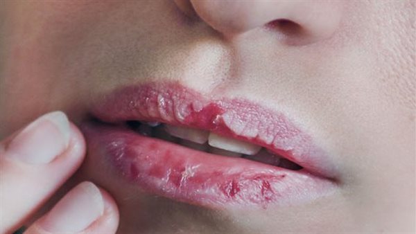 تشقق الشفاه