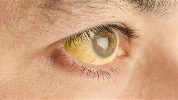 إصفرار العين
