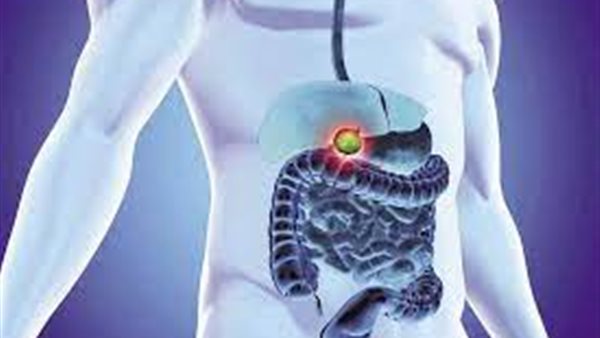 التهاب المرارة