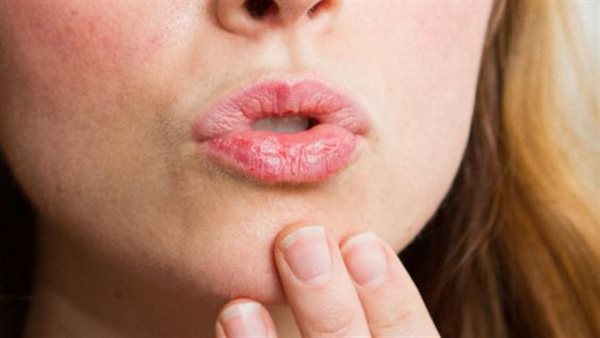علاج تشقق الشفاه