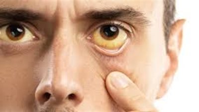  أعراض إذا لاحظت حول عينيك قم بفحص الكبد