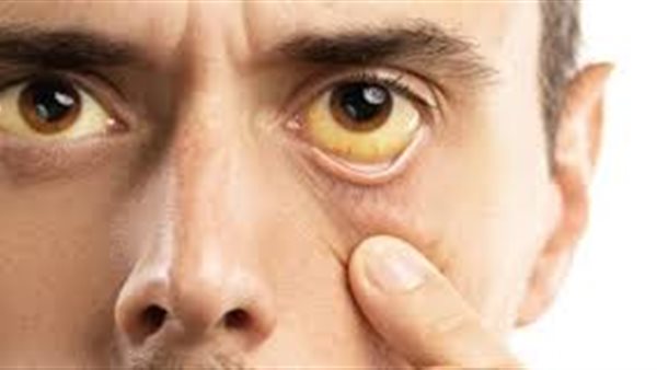 اعراض تشير لتليف