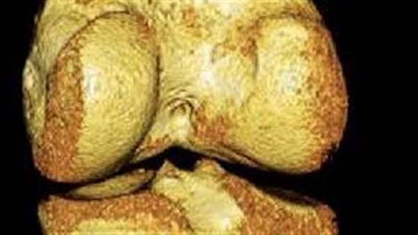 خشونه العظام