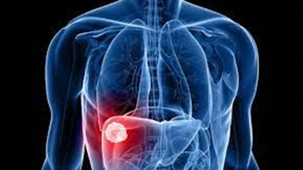 سرطان الكبد