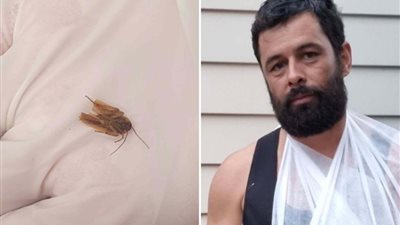 طبيب يخرج صرصار من أذن رجل بعد 3 أيام 