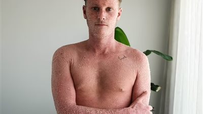 شاب يعاني من كابوس تقشر الجلد بسبب الكورتيزون