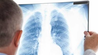 الكحة الجافة المصحوبة ببلغم.. تعرف على أعراض الالتهاب الرئوي 