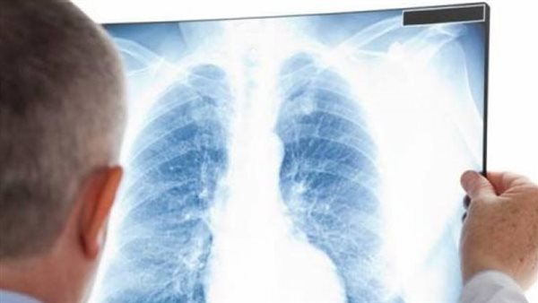  أعراض الالتهاب الرئوي