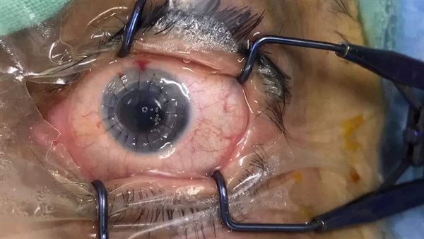 زراعة قرانية كامله