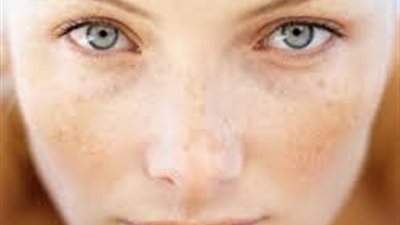 حلول فعالة للتلخص من تصبغات البشرة