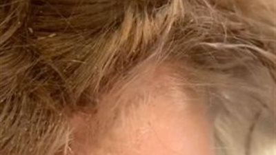 طفلة مصابة بعدوى مخيفة للقمل على رأسها ورقبتها