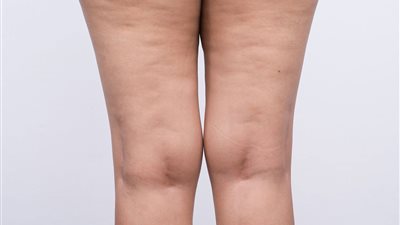 طرق فعالة في علاج السيلوليت.. تعرف عليها  
