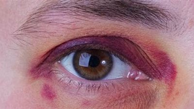 كيفية التخلص من الكدمات بشكل سهل وسريع.. تعرف على التفاصيل