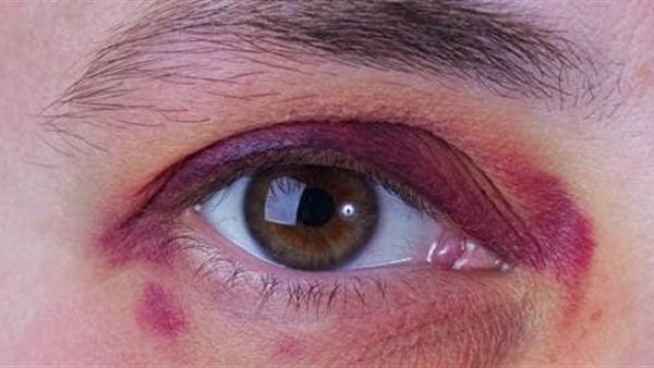 كدمات حول العين -