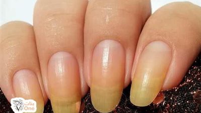 منها ترك المناكير لمدة طويلة.. تعرف على أسباب اصفرار الأظافر 