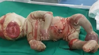 حالة نادرة.. سيدة بالشلاتين تضع طفلة شمعية دون أنف | صور وفيديو