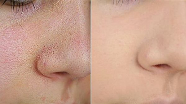 علاج المسامات الواسعة