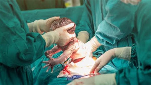 ولادة قيصرية- أرشيفية