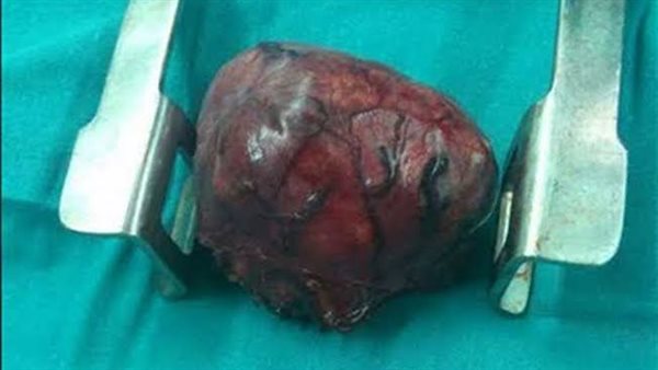 ورم-أرشيفية 