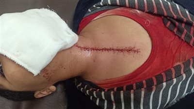 جريمة في مدرسة ابتدائي بالإسكندرية.. إصابة طالب على يد زميله بـ 100 غرزة