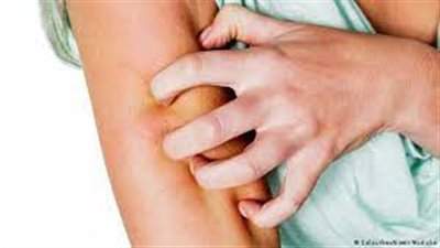 اجتمع عليهم المرض والحرب.. تفشي الجرب والجدري المائي بين أطفال غزة