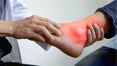 الإفراط في تناول الطعام يصيب بالنقرس|دراسة 