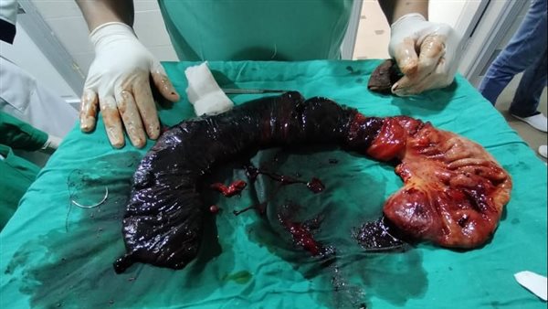 عملية جراحية نادرة