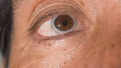 خبراء يحذرون: إذا لاحظت ذلك في عينيك قم بفحص قلبك