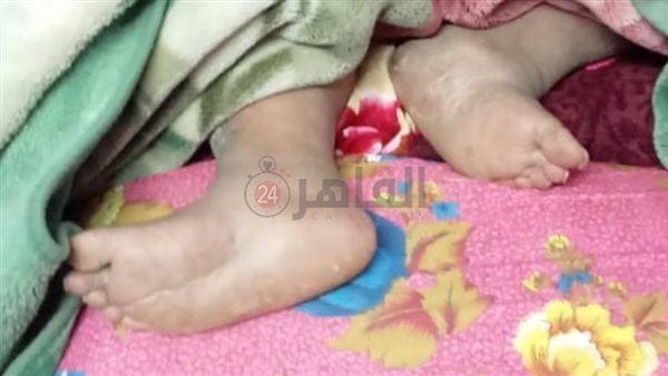 قدم السيدة المريضة