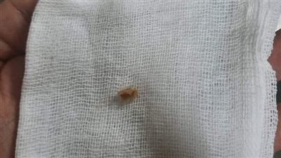 فريق طبي بمستشفى بنها الجامعي ينجح في استخراج قشره لب بالقصبة الهوائية لطفلة