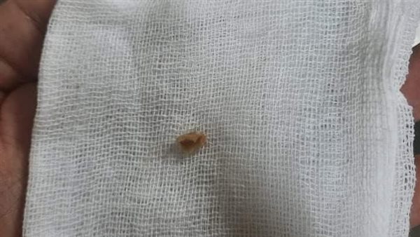 استخراج قشرة لب محشورة