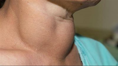 الشعور بالاختناق.. نجاح استئصال تضخم كبير بالغدة الدرقية لمريضة بمستشفى التضامن ببورسعيد 