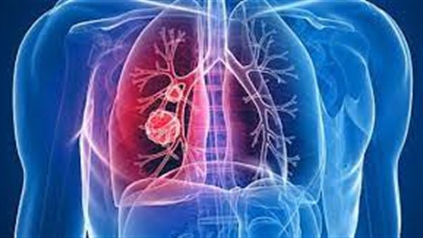 مرض الحويصلات الهوائية