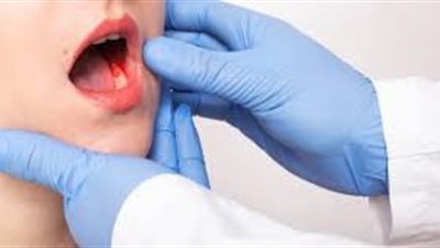 احذر.. وجود قرحة في الفم قد تشير لإصابتك بسرطان الفم