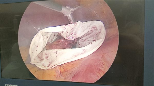 إستئصال ورم بالغدة