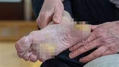 المصابون بمتلازمة أولمستد تدفعهم للانتحار| دراسة 