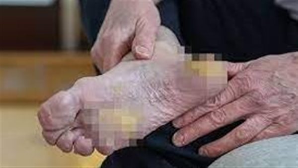 متلازمة أولمستيد